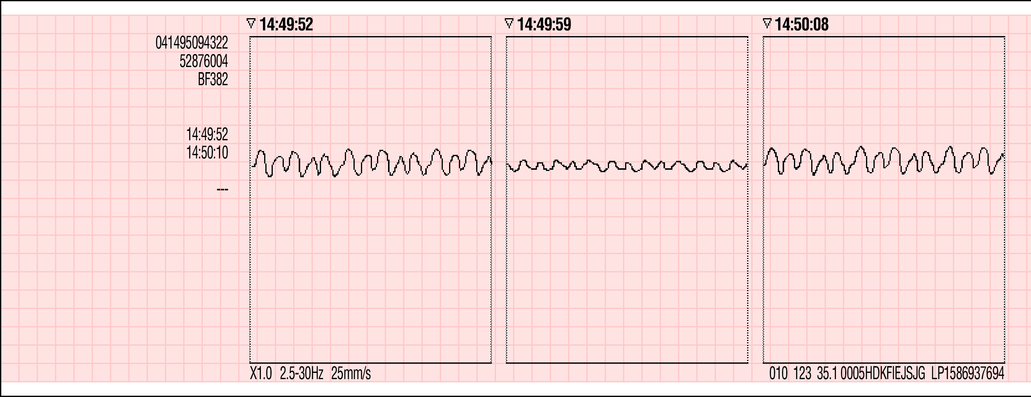 Analyshändelse Namn: Postens ID: Patient-ID: Incident: Ålder: 50 Lee, William Kön: M 24 Apr 2007 Segment 1 Defibrillerbar