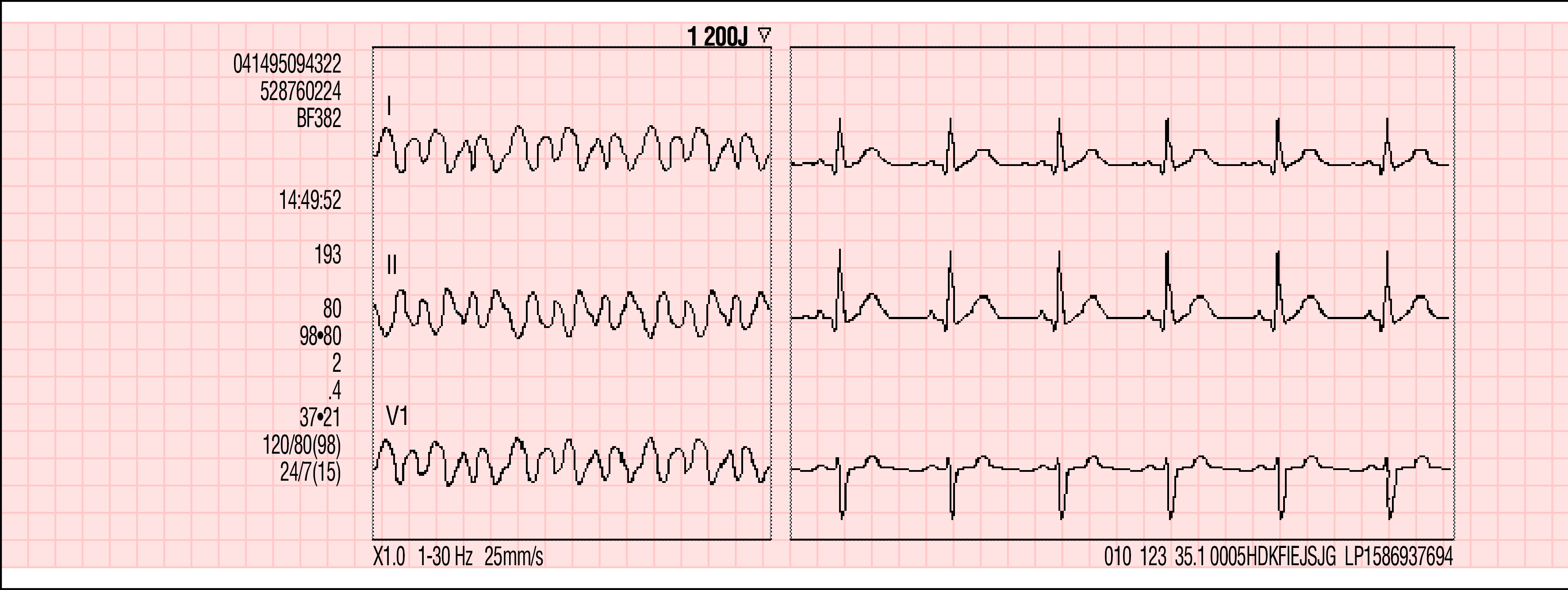 Postens ID: Patient-ID: Incident: Ålder: 50 Defibrillering 1 200J Impedans HF SpO2 PR SpCO SpMet EtCO2(mmHg) AF IP1 IP2