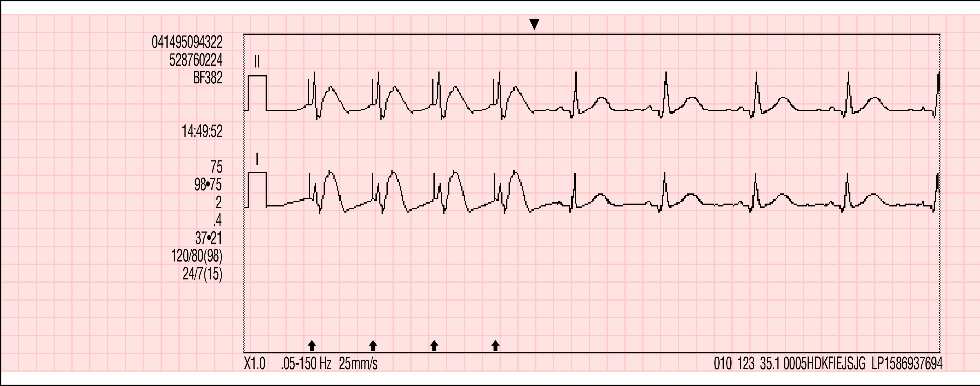 DATAHANTERING 7 Pacinghändelse Namn: Postens ID: Patient-ID: Incident: Ålder: 50 Lee, William Kön: M 24 Apr 2007 Pacing 6 avstannad Pacing 6 stoppad PR SpO2 PR SpCO SpMet EtCO2(mmHg) AF IP1 IP2 Figur