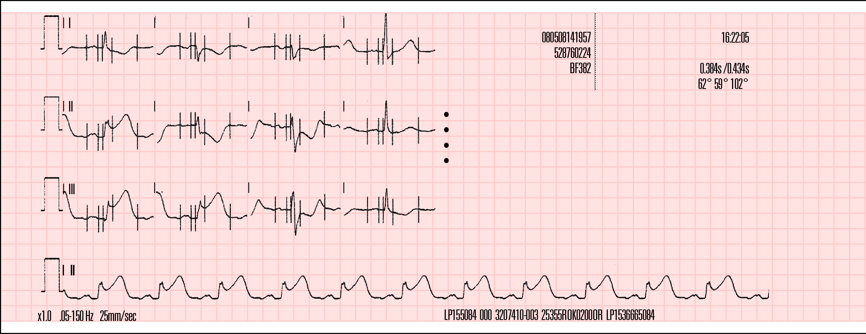 ÖVERVAKNING 4 Det 4-kanaliga formatet Figur 4-9 och Figur 4-10 ger exempel på utskrift av 12-avlednings-EKG i det 4-kanaliga formatet.