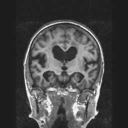 Alzheimers sjukdom Smygande förlopp Tidig minnesstörning