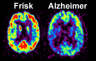 Vad händer i hjärnan vid Alzheimers sjukdom?