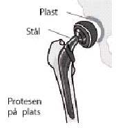 Den nya höftleden Operation: Vid en höftledsplastik ersätts den sjuka leden med en protes som består av ett metallskaft med ledkula och ledskål. Den nya leden cementeras vanligtvis fast.