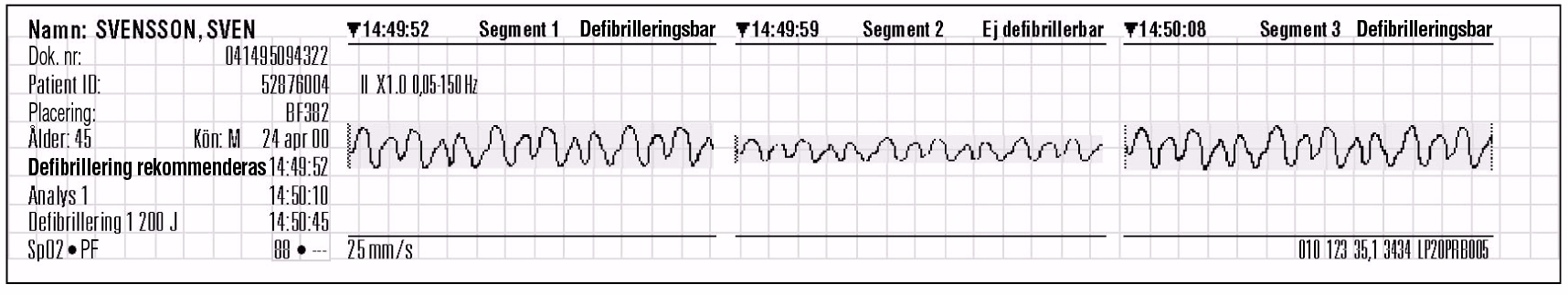 Datahantering SAS-händelse Namn: SVENSSON, SVEN Dok. nr: 041495094322 Patient-ID: 52876004 Placering: BF382 Ålder: 45 Kön: M 24 apr 00 Larm SpO2 <90 14:49:52 HF 121 SPO2 89 II x1,0.