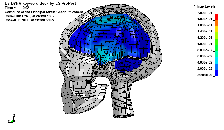 Figur 14. Maximala töjningen i hjärnan vid snett islag med rotation i islag mot hjälmens ovansida.