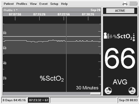 Grundläggande funktioner FORE-SIGHT monitor i MC-2000-serien Lägga till en händelsemarkering i patientjournalen Obs!