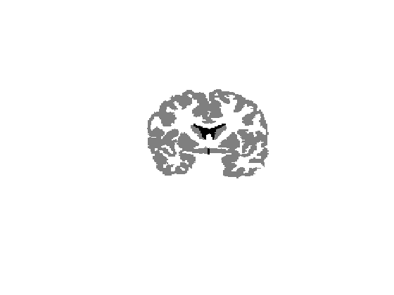 P17 A FULLY AUTOMATIC UNSUPERVISED SEGMENTATION FRAMEWORK FOR THE BRAIN TISSUES IN MR IMAGES Qaiser Mahmood 1,2, Artur Chodorowski 1,2, Mikael Persson 1,2 1 Department of Signals and Systems,