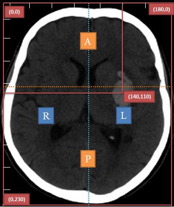 83 P18 LOCALIZATION OF HEMORRHAGIC STROKE USING MICROWAVE TECHNOLOGY Jasila Prabahar 1,2, Stefan Candefjord 2,3, Andreas Fhager 2,3, Mikael Persson 2,3, Mikael Elam 3, 4 1 Linköping University,