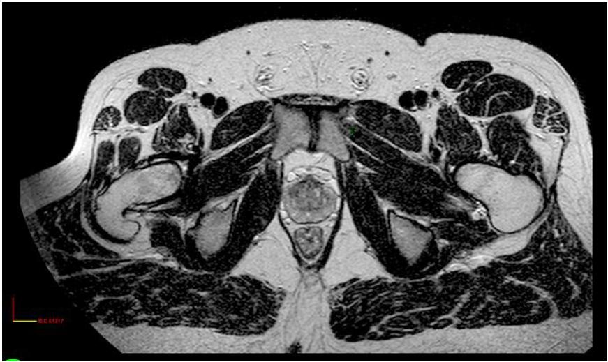 modality for the radiotherapy treatment process of localized