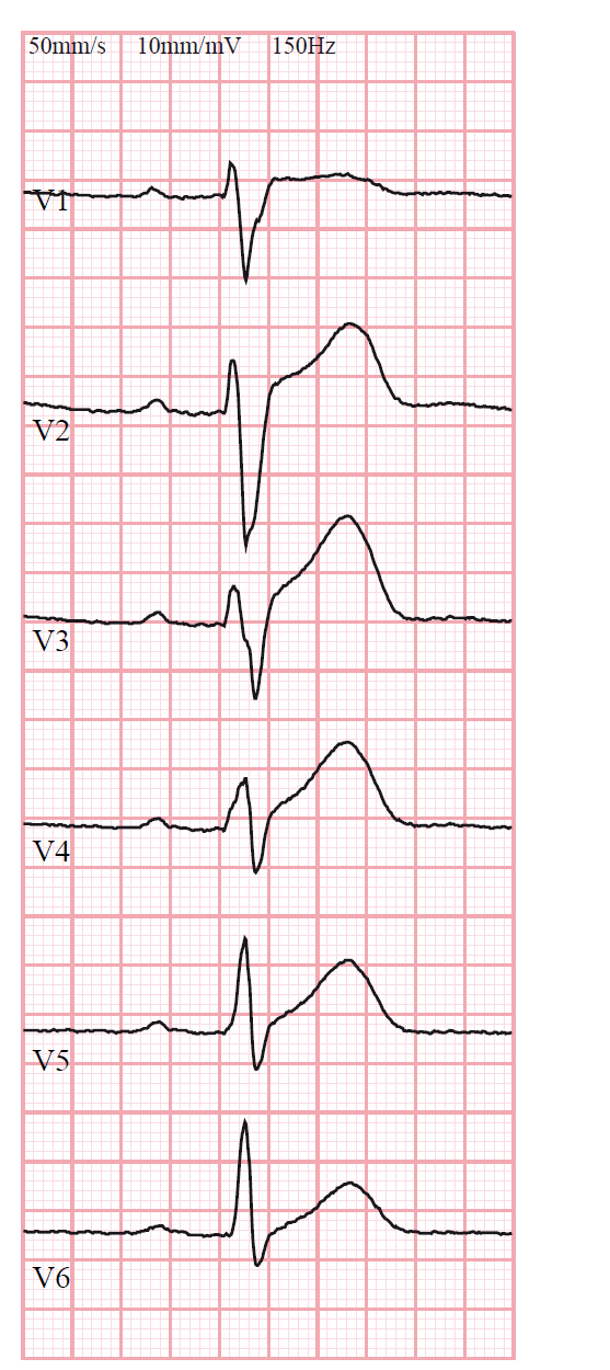 4. EKG, arytmier och antiarytmika (4,5 p) EKG är registrerat enligt svensk standard(pappershastighet 50 mm/s samt förstärkning 1 mv = 10 mm på pappret).