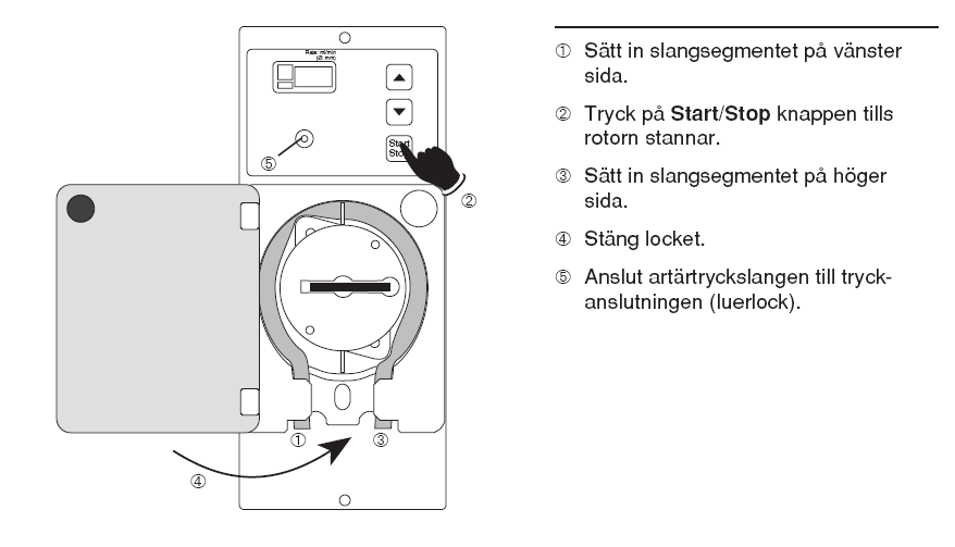 Bilaga 2 Hemodialysbehandlingen i detalj Delprocess 1: Uppstart och testfas Först startas vattenrenaren sedan Fresenius 4008S. Den röda dialysatslangen ansluts till Smartbag (A-koncentratpåsen).