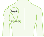 Men EKG kan vara tyst V7-V9: Posterolateral infarkt (vid isolerad