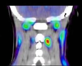 Experimentellt stöd Välgrundat teoretiskt stöd för betydelsen av Cervikal proprioception för postural jämvikt & postural orientering Störd cervikal proprioception kan antas orsaka yrsel under vissa