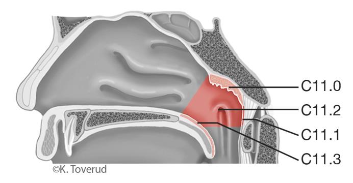 NASOFARYNXCANCER 12.10 Nasofarynxcancer 12.10.1 Översikt ICD-10 Övre vägg C11.0 Bakre vägg C11.1 Lateral vägg inkl. fossa Rosenmüller C11.2 Inferiora väggen, dvs. mjuka gommens C11.