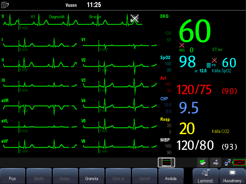 8.9 Övervakning av 12-avlednings-EKG 8.9.1 Visa skärmen för övervakning av 12-avlednings-EKG 1. Se avsnittet 8.3.3 EKG-elektrodplaceringar för information om placering av elektroder. 2.