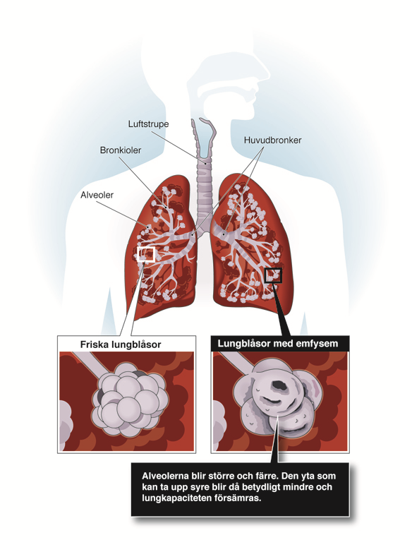 Även luftföroreningar ökar risken för KOL. Den som har haft astma sedan barndomen och därefter varit rökare löper stor risk att som äldre även drabbas av KOL.