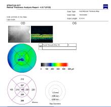 Prevention/intervention Interventionsstudie Antiox/placebo Randomiserad dubbel-blind Psykofysiska funktionstester Bästa korrigerade synskärpa Foveafunktion Imaging Fundusfoto Makulatjocklek