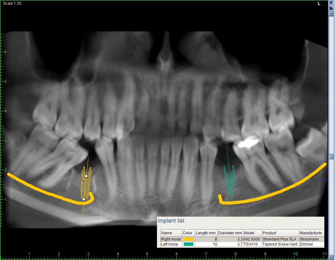 IMPLANTATMODULEN 5 IMPLANTATMODULEN Romexis implantatmodul tillhandahåller verktyg för att planera en implantatplacering i en 3D-volym.