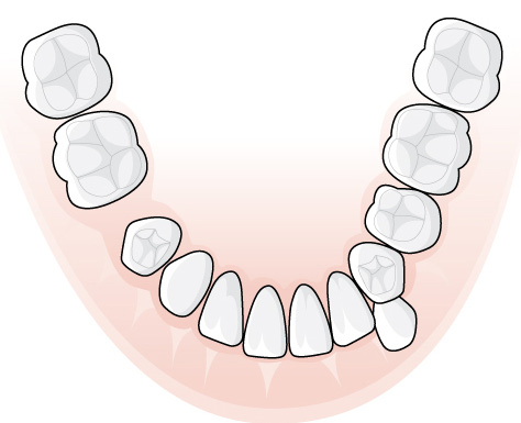 22 (107) 1.3.3.1.2 Exempel, tand 34 står i tandposition 35, en entandslucka har uppkommit Hos en patient har efter tidig extraktion av tanden 36 en distal tandförflyttning skett av tänderna 34 och 35.