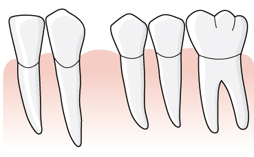 Beroende på tandförflyttningarna finns nu en entandslucka i tandposition 34 och en bro är ersättningsberättigande. 1.3.3.2 Två tänder kan ha samma tandposition Som framgår av definitionen gäller den för tänder som står i tandbågen.