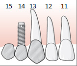 48 (107) 6.2.3.1.2 Exempel, hängande led bredvid implantat där regel E.