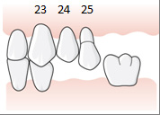 60 (107) 6.3.3.2.5 Exempel, betthöjning på grund av utrymmesbrist En patient har inga tänder bakom 13 på höger sida i överkäken samt en tretandslucka 24 26 på vänster sida.