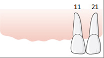 76 (107) I exemplen i bilden ovan kan regel E.2 tillämpas när ett implantat inte kan placeras inom tandposition 5 5. Då ersätts istället ett implantat med implantatkrona i tandposition 6.