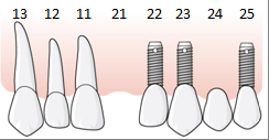 med två implantat, åtgärd 852, och ett hängande led, åtgärd 853,