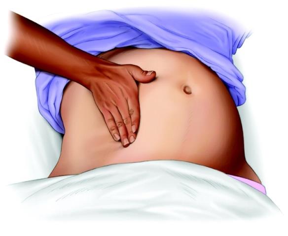 Av 50 maternella dödsfall 20 under graviditet (8 tidig graviditet) 10