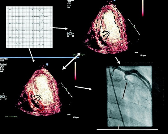 Figur 1. En 29-årig man söker akut med atypisk bröstsmärta. EKG (överst till vänster) visar diskreta ST-lyft och bedöms initialt som perimyokardit.