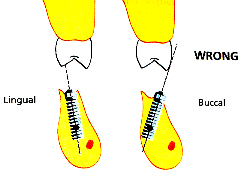 I överkäken: mot buccala kuspen I underkäken: mot linguala kuspen Implantatets position & lutning (I) Viktigt att