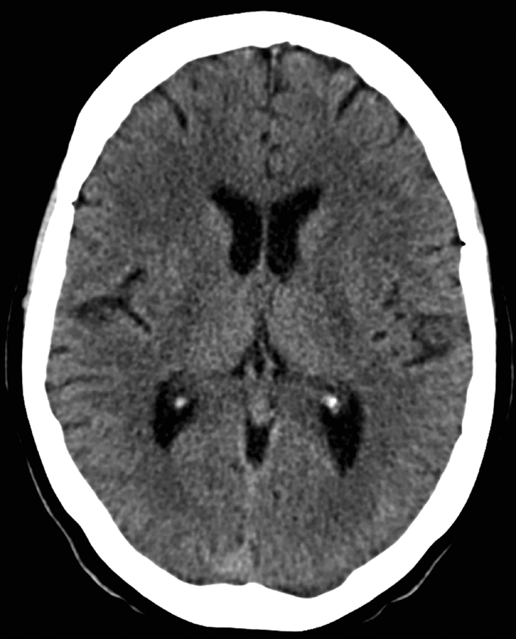 Gun Skytte 460613-3345 2004-11-10 UMAS Utlåtande DT hjärna 2004-11-10: Inga tecken på blödning, infarkt eller expansiv process. Ventriklar och övriga liquorrum är normala. Öppna basala cisterner.