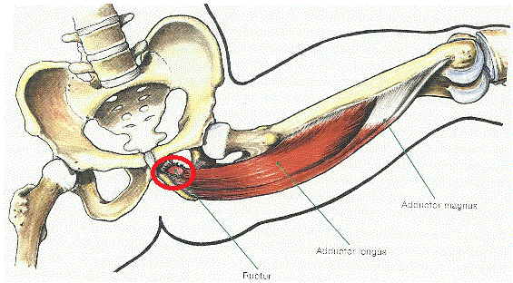 Figur 9. Adduktorruptur är inringat. (Bahr & Maehlum 2004 s. 251). 4.5 Underbensskador Akuta skador i underbenet är relativt ovanliga medan kroniska belastningstillstånd är mer vanliga.