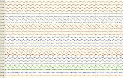 ångest, agitation, hallucination, inpräglingsstörnin, epileptiska anfall koma, hypoventilation, autonom dysfunktion, bisarra motorikstörningar FÖRBÄTTRING Dalmau et al i Lancet Neurology jan 2011