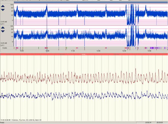 Excitotoxisk hjärnskada även vid fokala SE SB EEG 12-24 h Status Epilepticus-Induced Neuronal Loss in Humans Without Systemic