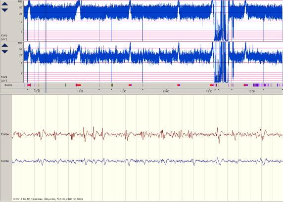 Epilepsia 41(8) 981-991, 2000 EEG: repetitiva sharp-waves uni- eller bi-temporalt duration 8.