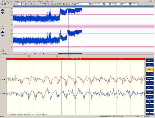 EEG tidpunkt Kontinuerlig elektrografisk anfallsaktivitet höjer trenden även mellan de tre kliniska motoriska anfallen Muskelstörningar höger sida Anfallsaktivitet ses på både vänster (C3-P3) och