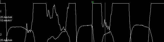 Ett annat problem var att vissa av de normala QRS-komplexen inte fått någon märkning alls, vilket krävde manuell märkning.