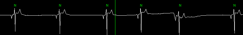 Medelhjärtfrekvens hos friska respektive DCM DCM Friska 50 60 70 80 90 100 110 Hjärtfrekvens slag/min Figur 14: Boxplot över medelhjärtfrekvens hos friska hundar respektive hundar med DCM.