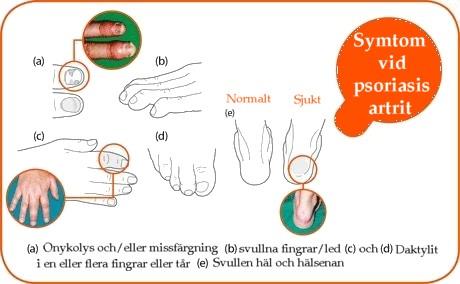 Psoriasis artrit Klinik Artrit och psoriasis, eller artrit och minst 2 av följande: 1. Daktylit (svullnad av en eller flera fingrar eller tår, vanligen asymmetriskt och sträcker sig över ledgränsen.