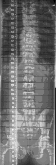 Den konventionella röntgenutrustningen gav ett DAP-värde på 1,789 Gycm 2 och undersökningen med genomlysningsutrustning