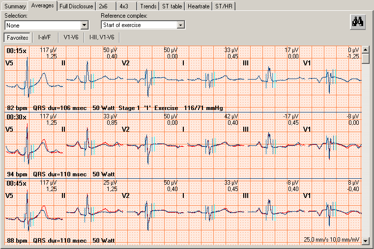 Trender och diagram ST-tabell Hjärtfrekvenstrend ST-trend Blodtryck En översikt över ST-värdena som beräknades i vyn ST-tabell. Hjärtfrekvensens trend som beräknades i vyn Hjärtfrekvens.