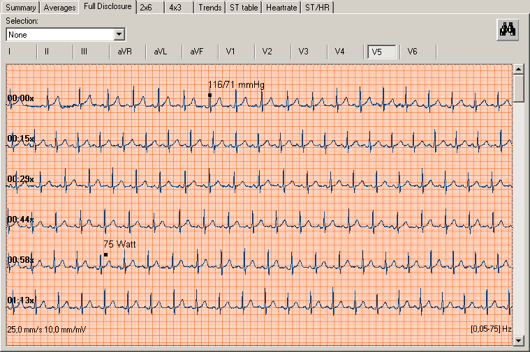Så här byter du från översiktsdata till genomsnitt: CardioPerfect Workstation 1. I vyn Översikt klickar du med den högra musknappen på den punkt som du vill se i vyn Genomsnitt. 2.