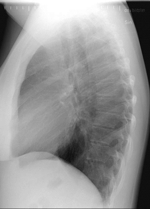 Lungröntgen Normal Bilder