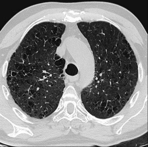 CT thorax - KOL