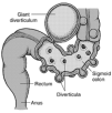 Diverticulosis Tjocktarmssjukdomar: 5.