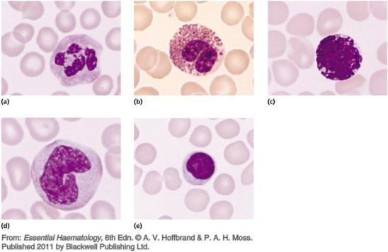 8. Du ser här skillnad på överlevnad hos erytrocyter hos en person med normal överlevnad och en som har en hemolytisk anemi. a.vilken cell syns i ökad omfattning i diffen hos en person med hemolytisk anemi?