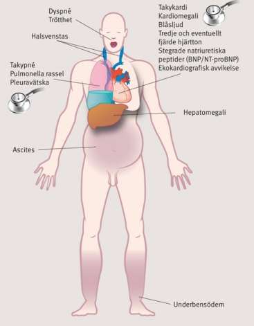 2013-10-23 Vanliga fynd och symtom vid hjärtsvikt