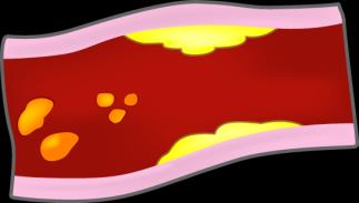 Depression en systemsjukdom 2. The adrenal gland releases excessive amounts of catecholamines and cortisol 3.