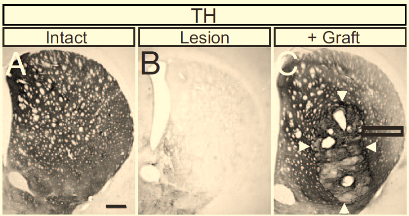 neurons NesE-Lmx1a: 75-95% dopamin. neurons Transplanted cells re-innervated lesioned striatum, after 4 weeks.